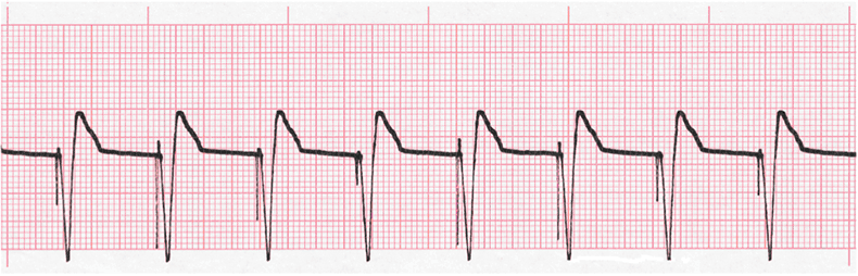 Single chamber pacemaker atrial fibrillation